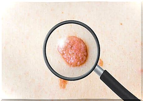 Observation of a skin tumor with a magnifying glass. 