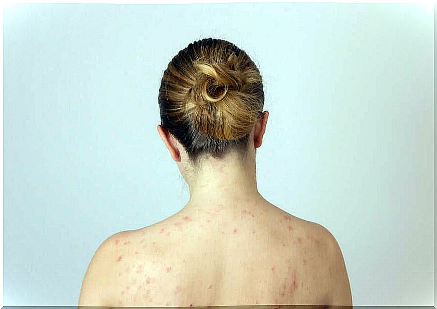 A woman with fat pimples on her back 