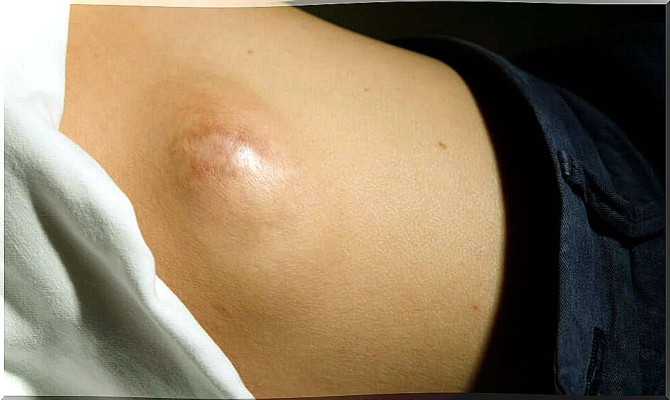 Giant lipoma is one of the fat balls that can appear on the back