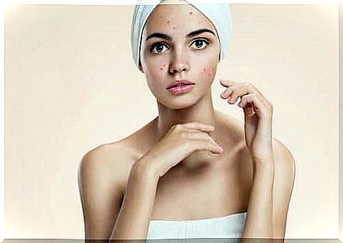 Acne-prone skin 