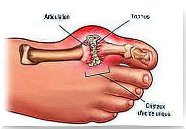 Uric acid