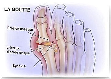 Gout disease