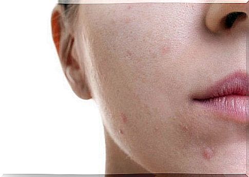 Natural treatment for rosacea