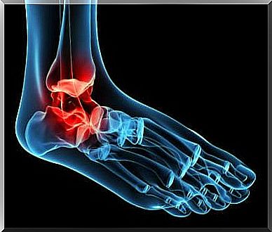 ankle arthritis