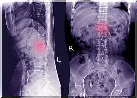 X-ray of a spondylolisthesis