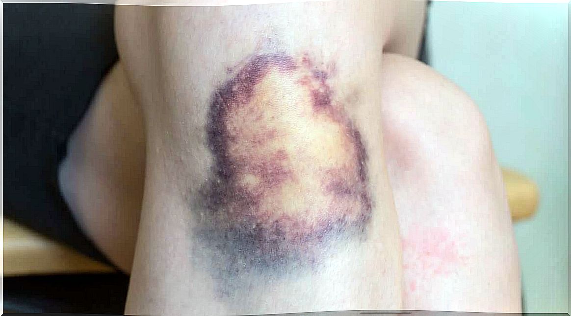 Significant hematoma on one knee. 