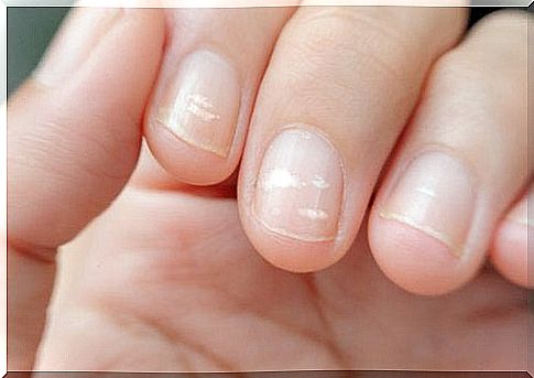 zinc deficiency can cause lines on the nails